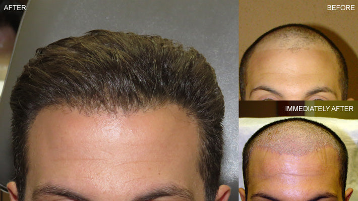 Why Choose Non Surgical Hair Restoration?