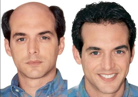 How Do Hair Replacement Systems Work